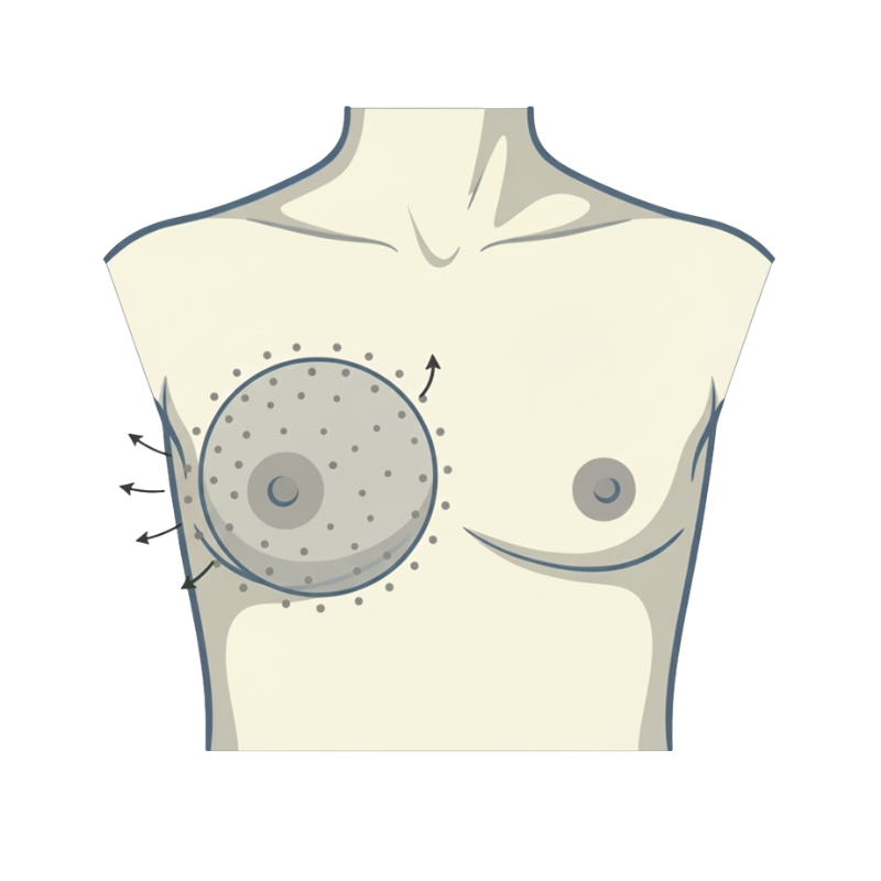 Composite Breast Augmentation
