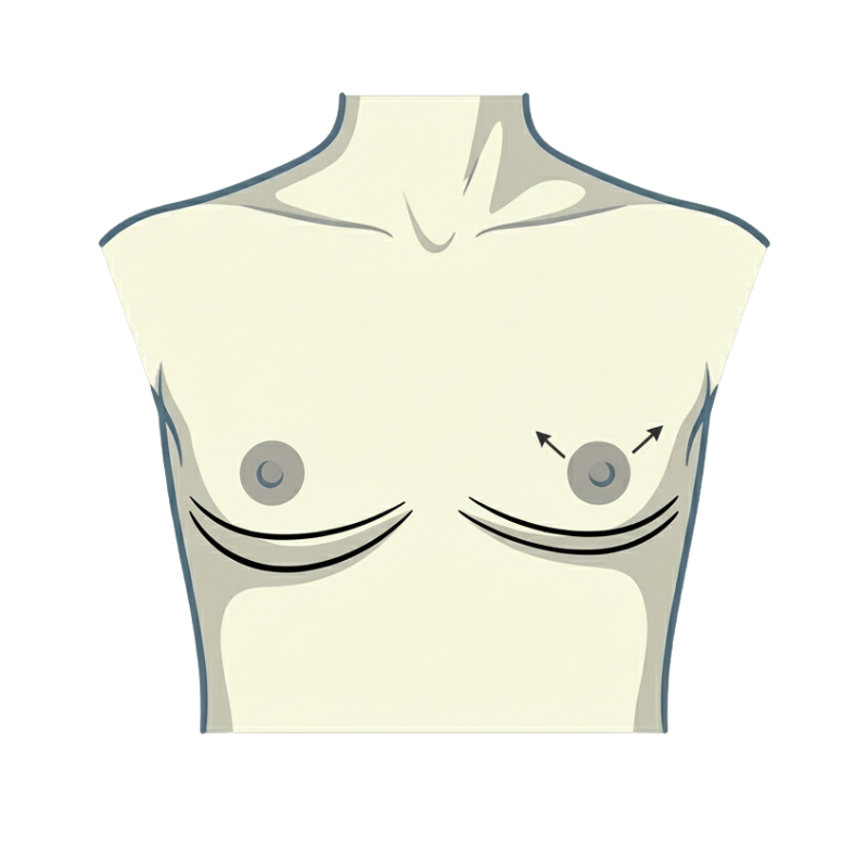 Double Incision mit freier Warzentransplantation