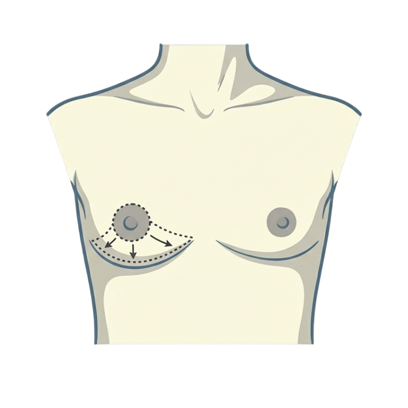 Der periareoläre Schnitt