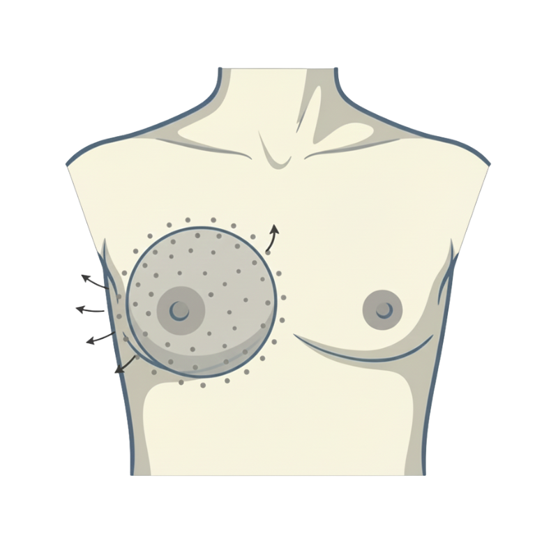 Composite Breast Augmentation